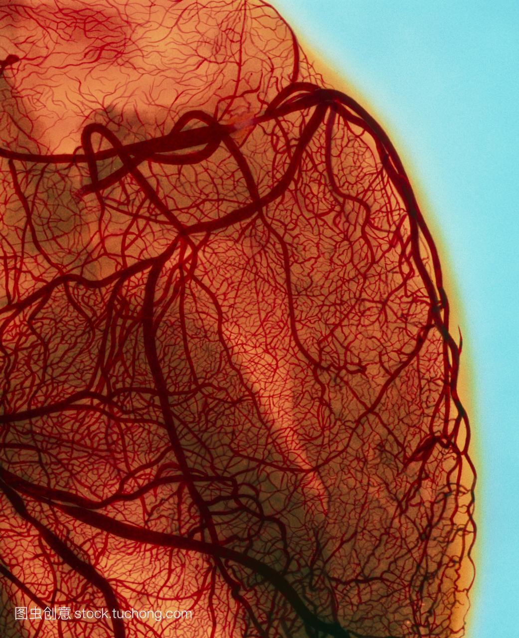 血管造影显示冠状动脉狭窄阻塞,动脉是血液供
