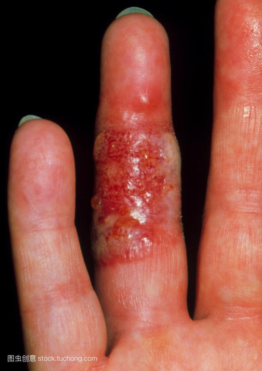 疱疹在手指上。由单纯疱疹病毒1型hsv1感染引