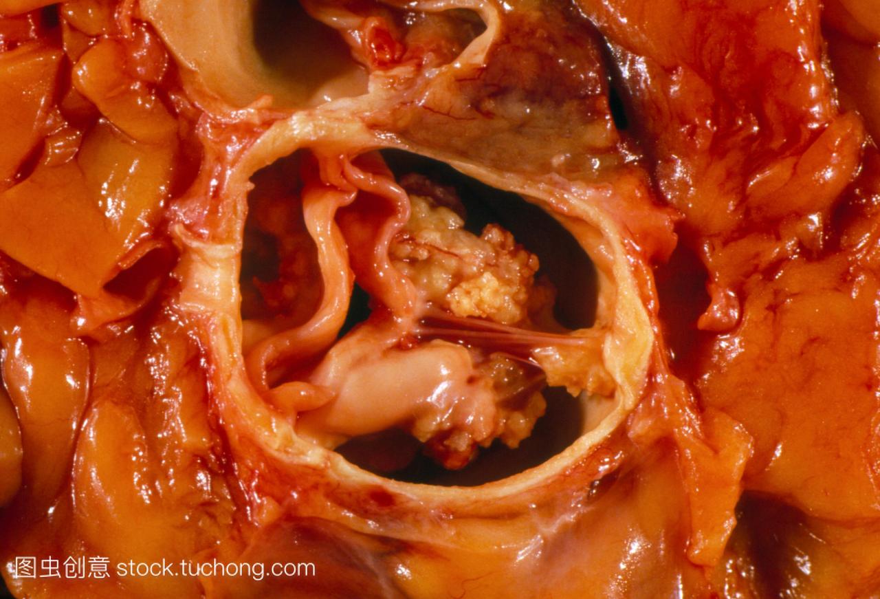 ub-aortic狭窄的心。总截面的标本通过主动脉动