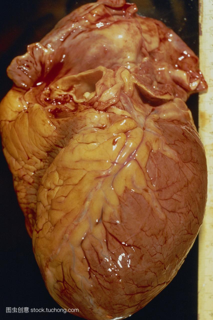 扩大的心脏。心脏肿大心脏肿大的总样本。这是