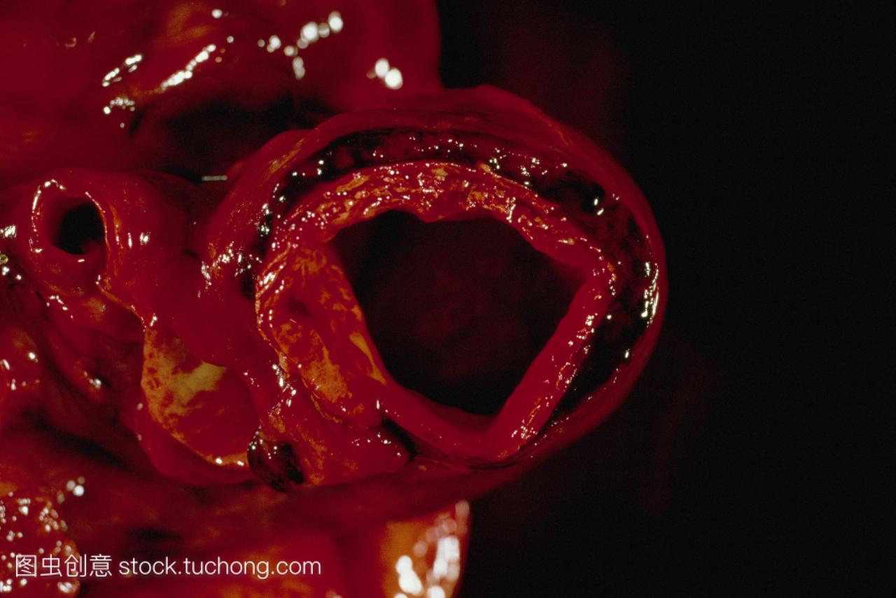 剖总值动脉瘤标本的截面的主动脉夹层动脉瘤圆