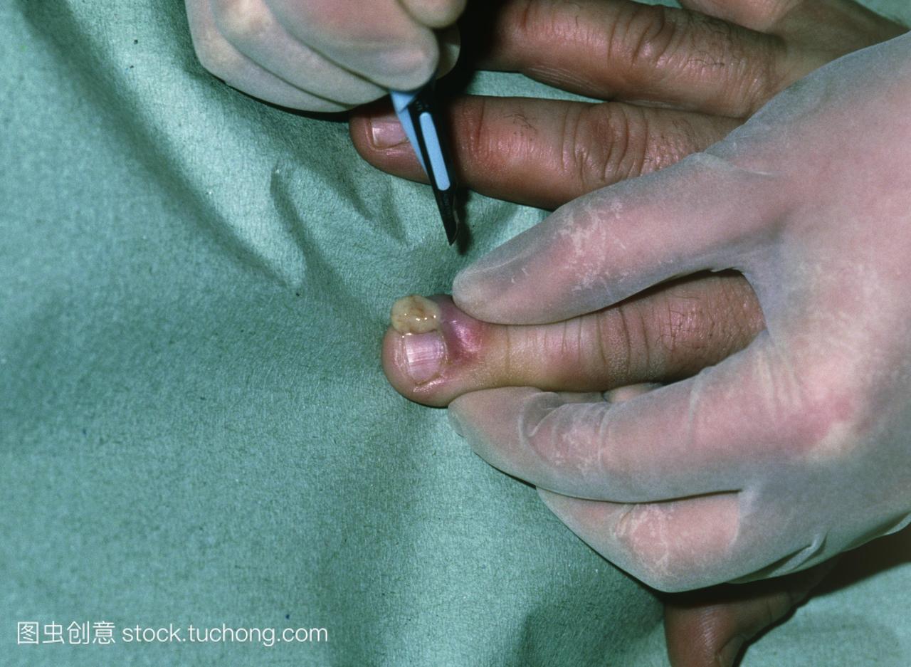 甲沟炎感染切开排脓的脓肿形成脓肿形成一个手