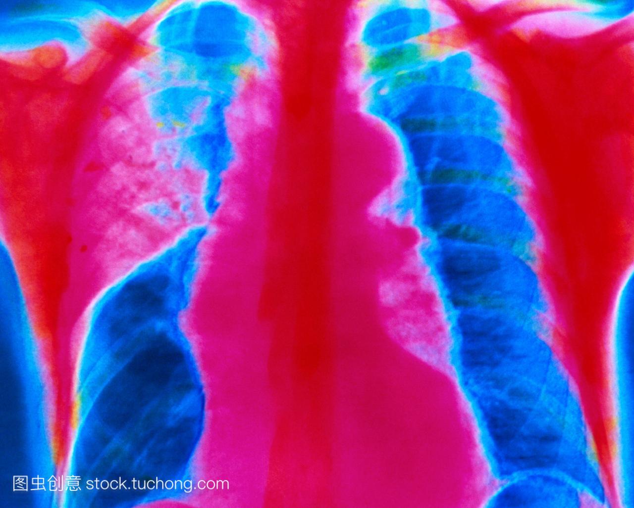 急性大叶性肺炎。彩色的胸部x光片显示急性肺