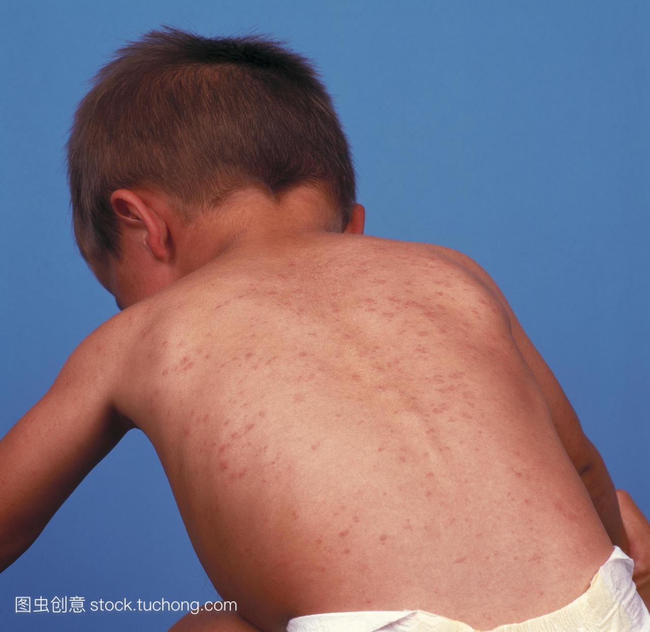 麻疹在孩子的背上起疹子。麻疹是一种传染性极