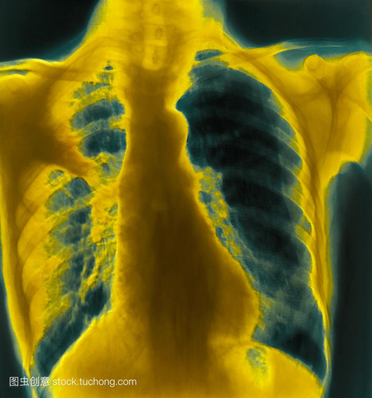 急性肺炎支原体的。彩色胸部x光显示病人肺上
