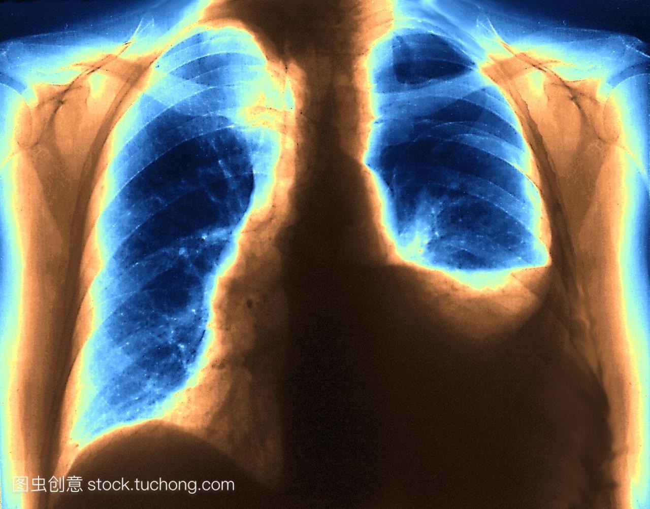 水气胸。彩色胸部x光显示病人的左肺蓝色,右上