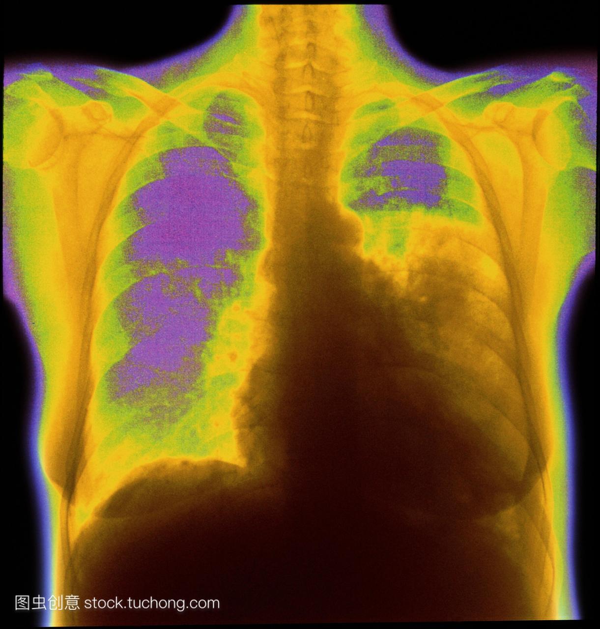 大叶性肺炎。彩色委员会的胸部x光片显示病人