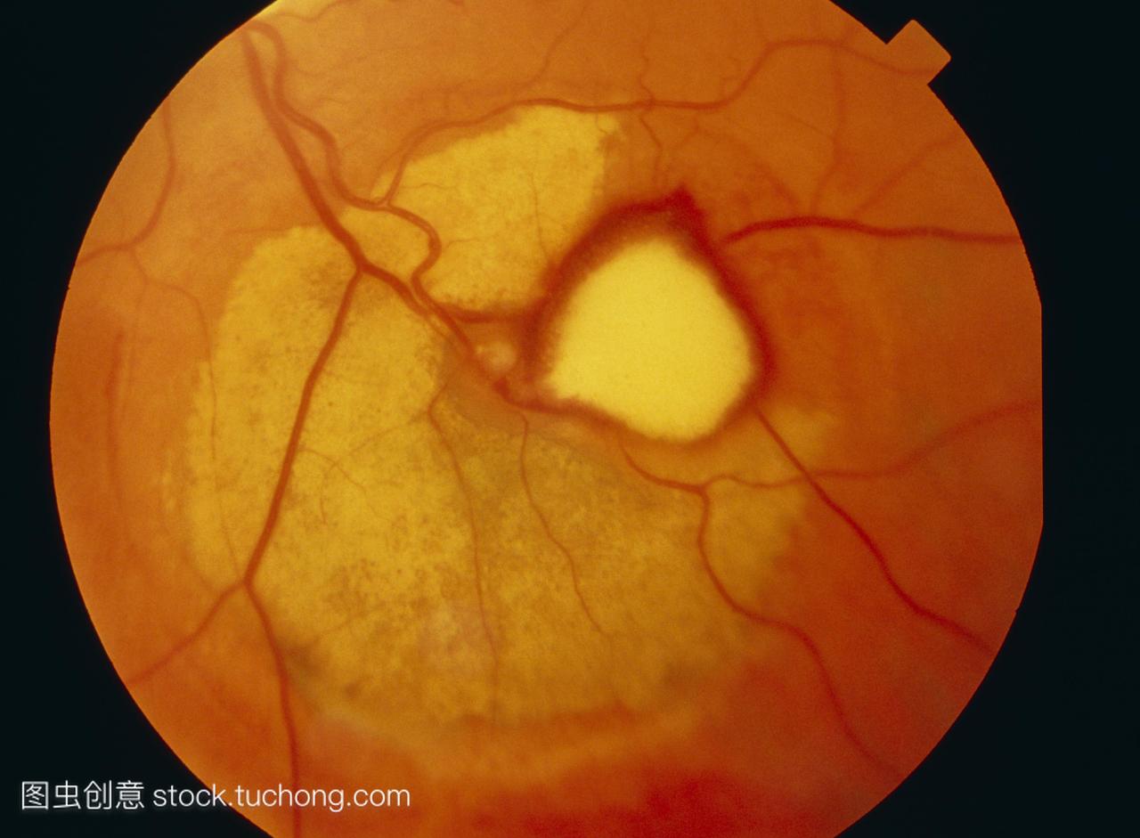 视网膜血管瘤。检眼镜对眼睛的视网膜大动脉瘤