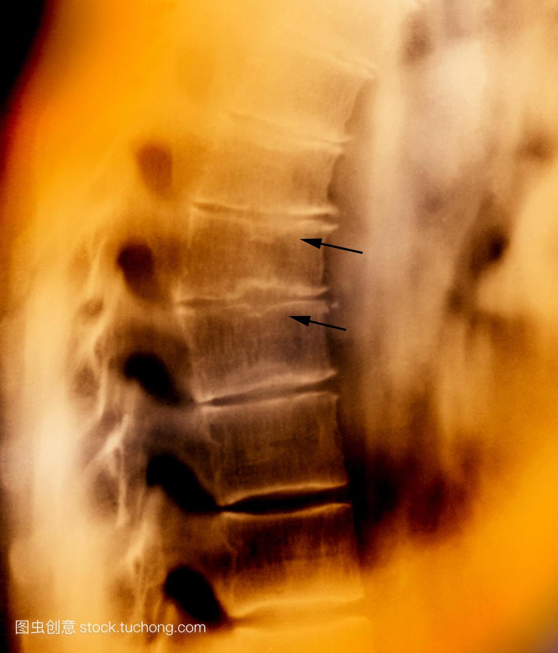 T计算机断层扫描扫描的椎骨骨头的骨干脊柱本