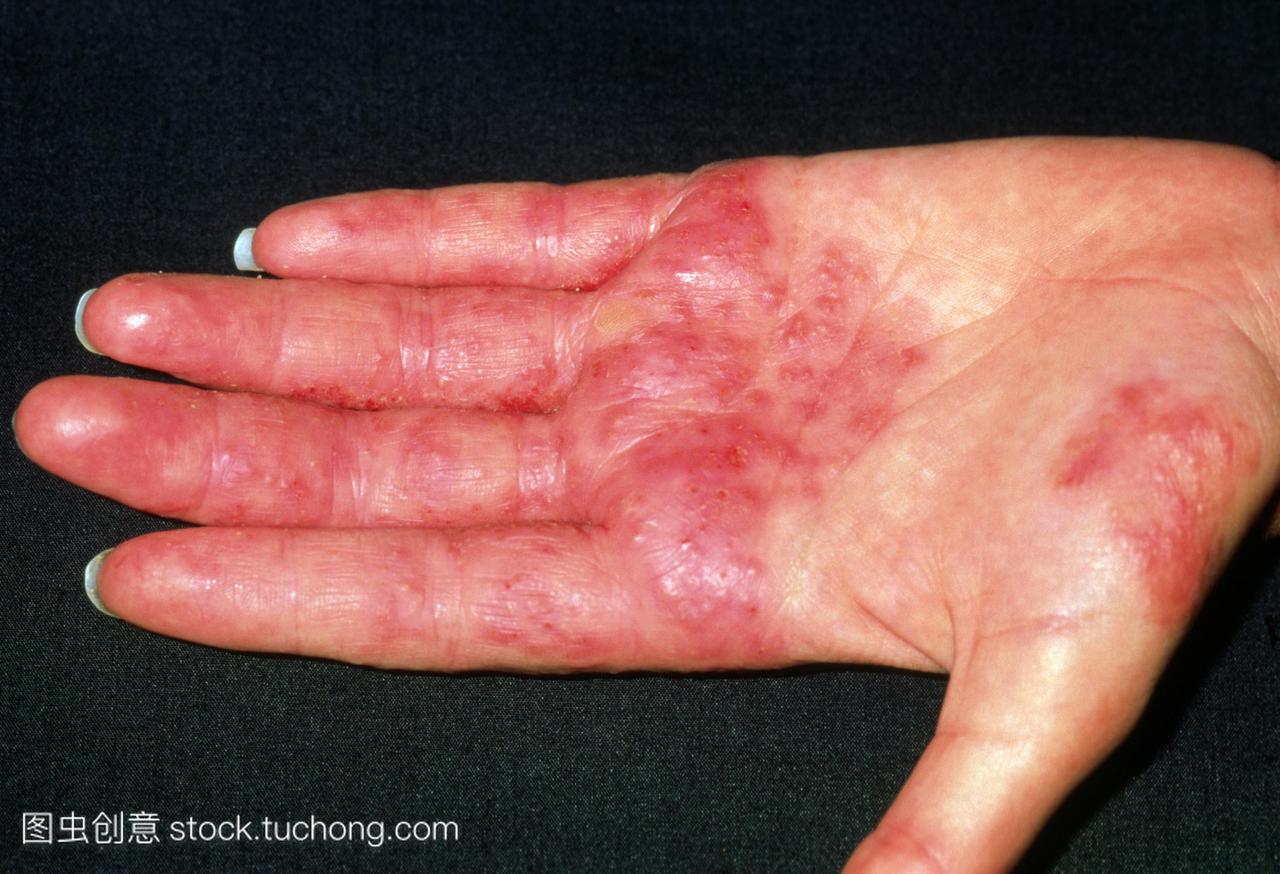 接触性皮炎。视图的手一名21岁女子理发师显