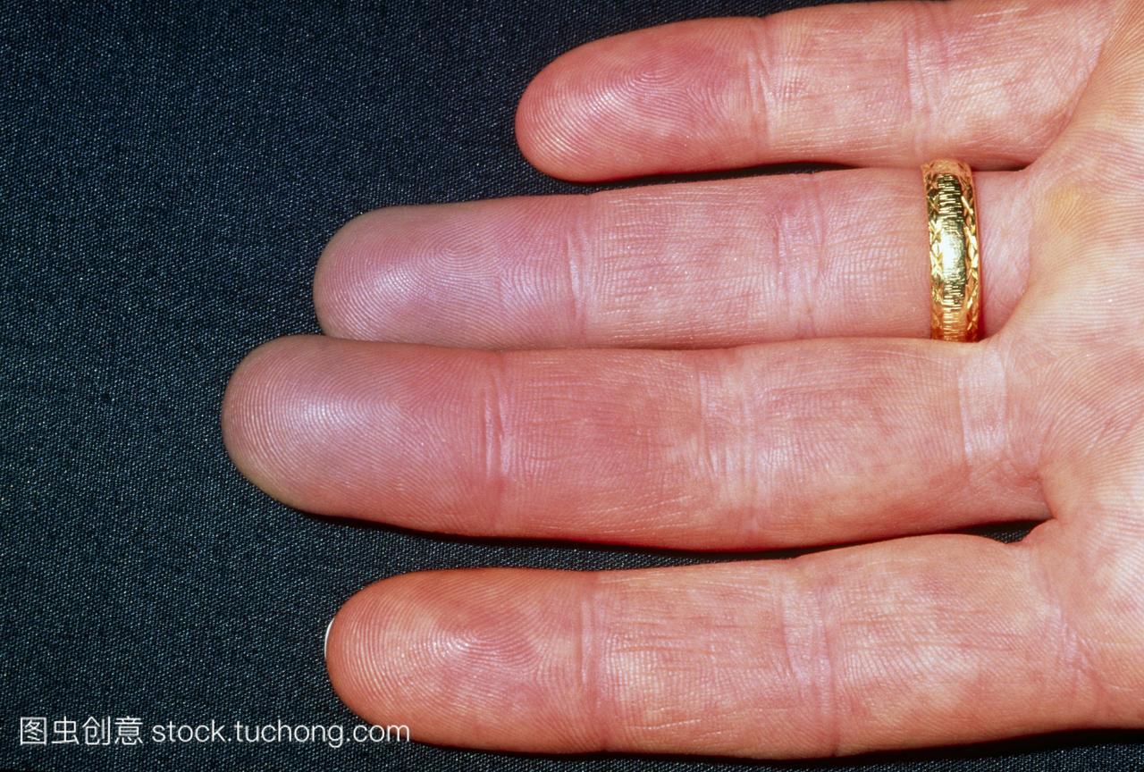 雷诺氏现象。一个35岁的女人的手的手指变色
