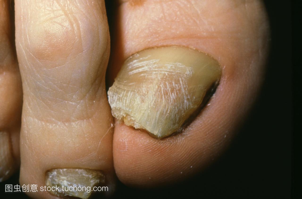 脚趾甲的慢性真菌感染。这是被称为甲癣或on