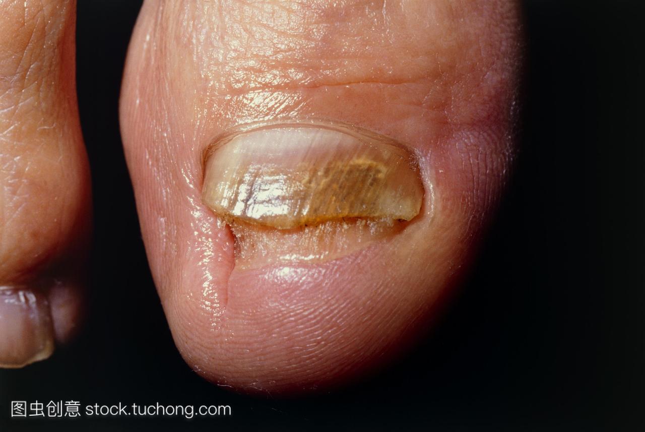 脚趾甲的慢性真菌感染。这是被称为甲癣或on