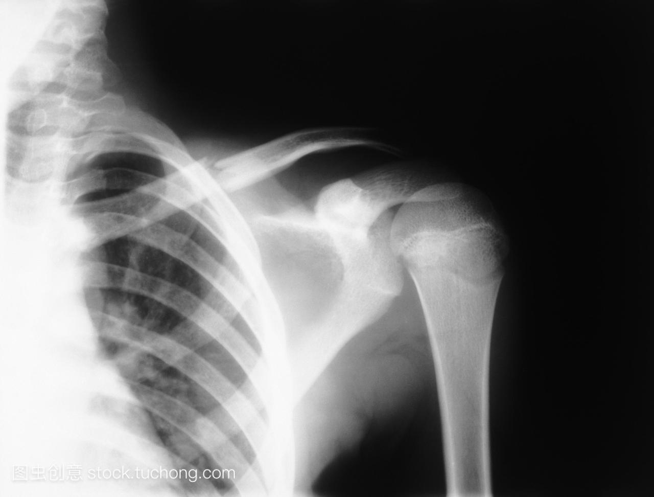 x射线照片上胸部和肩膀的关节显示一个简单的