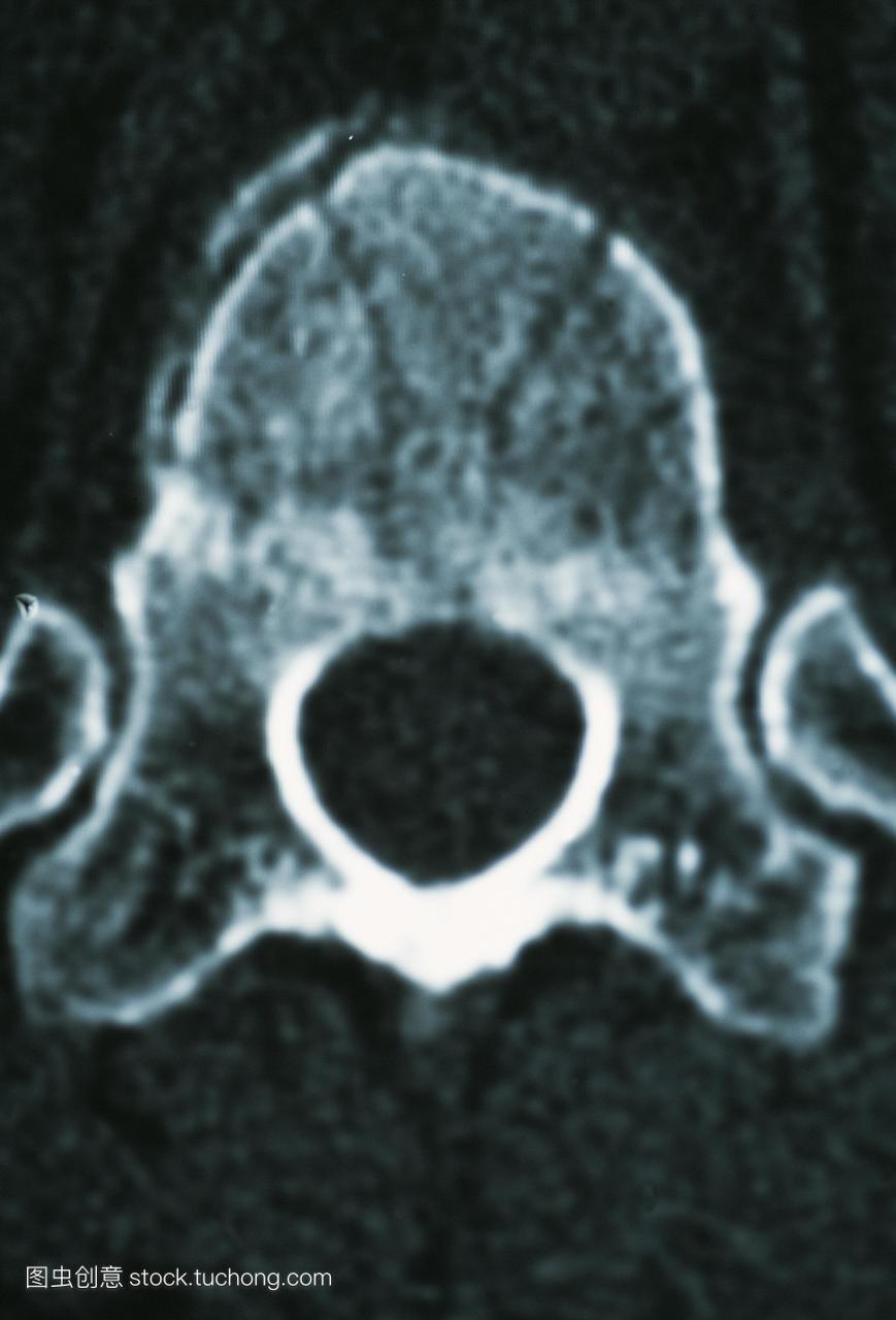 脊柱骨折的计算机断层扫描ct扫描截面椎骨骨折