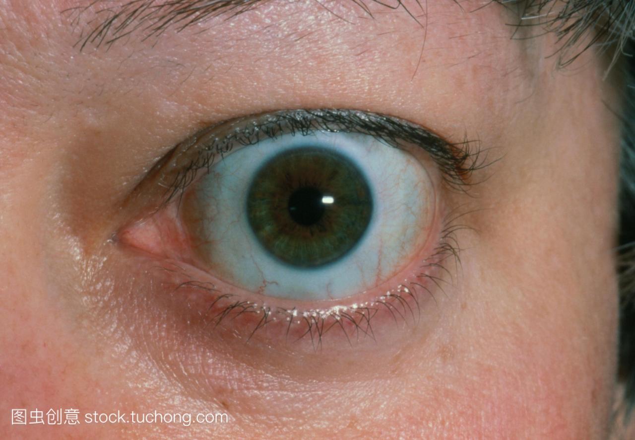 眼睛在甲状腺功能亢进。特写一个女人的膨胀眼