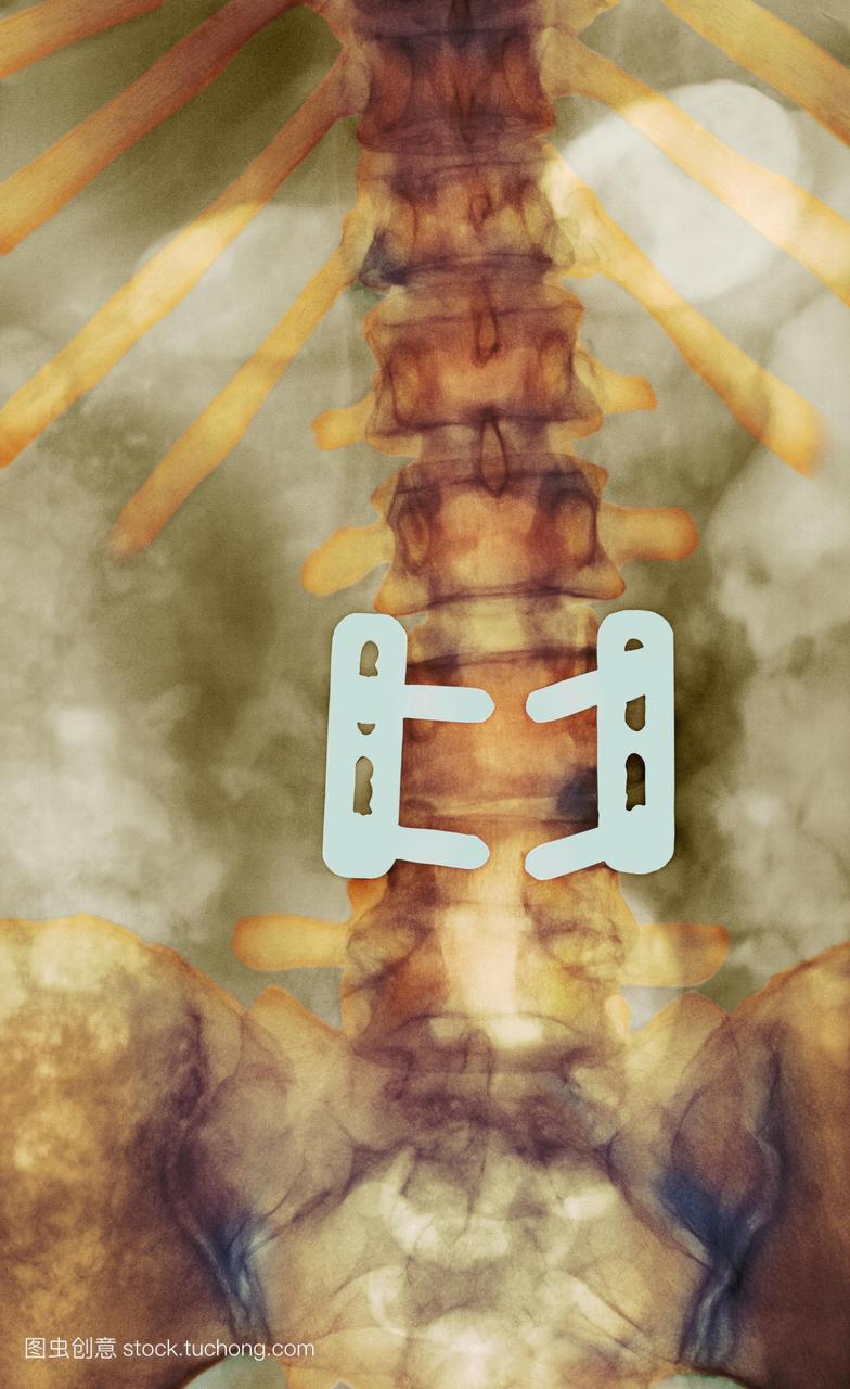 固定的椎骨。彩色x光片蓝色连接了一个29岁的