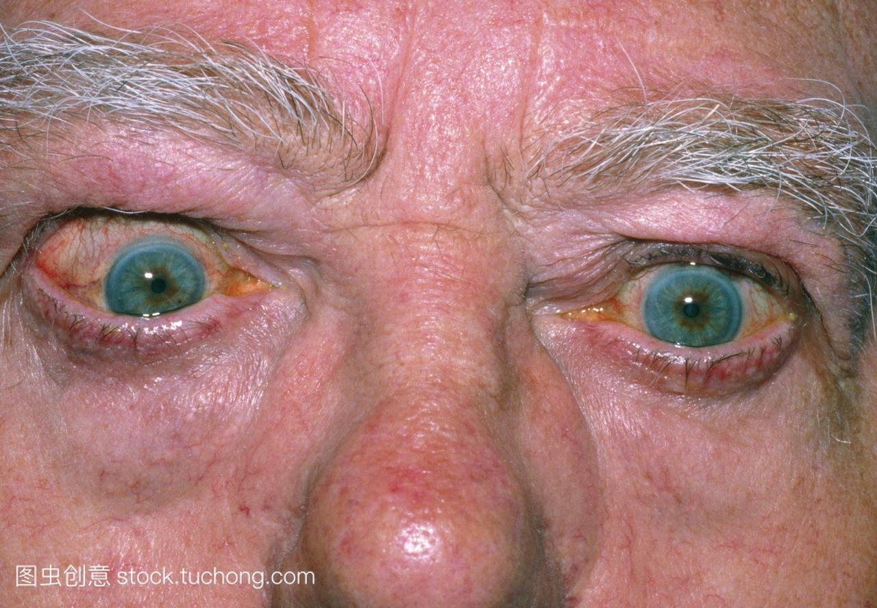 甲状腺功能亢进。前视图甲状腺毒症的人的眼睛