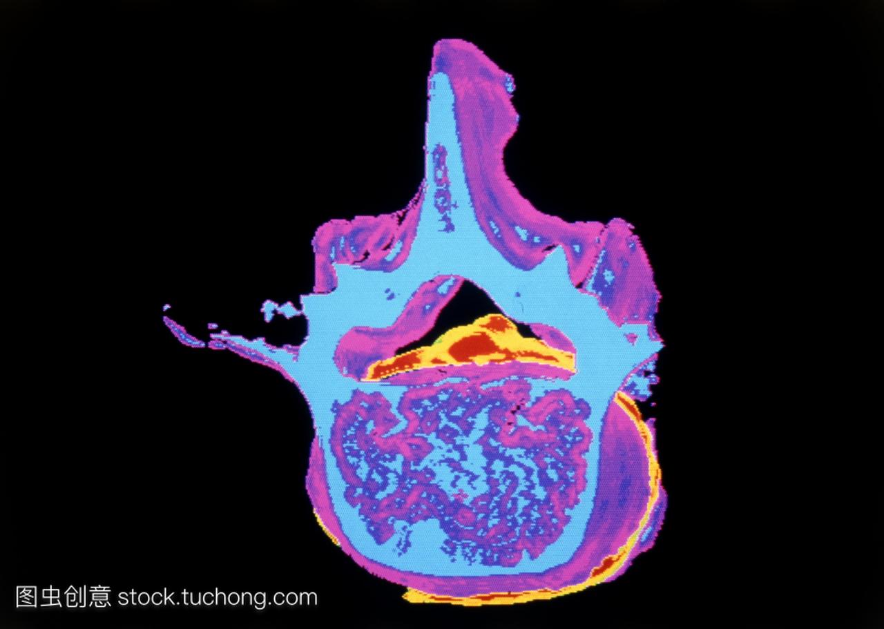 伪彩色计算机断层扫描CT扫描的下滑脱垂腰椎