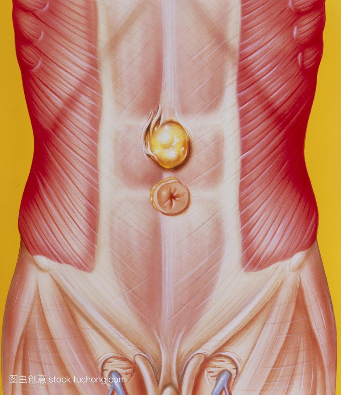 腹部疝。图示成年男性的腹壁疝。在这里看到的