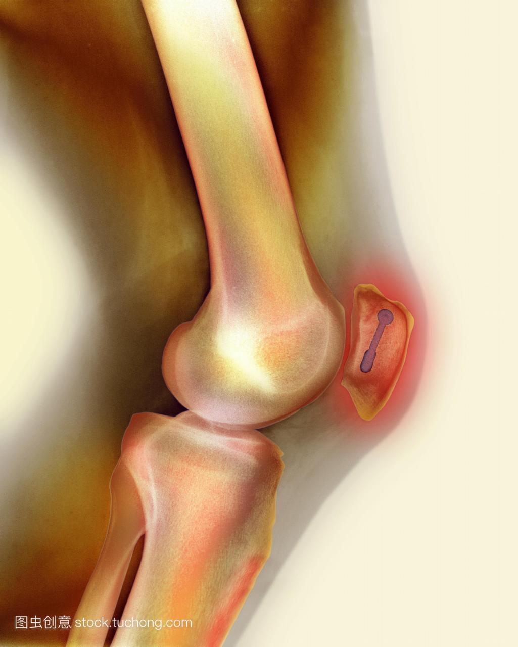 固定的膝盖骨骨折。彩色的x射线的销灰色中心