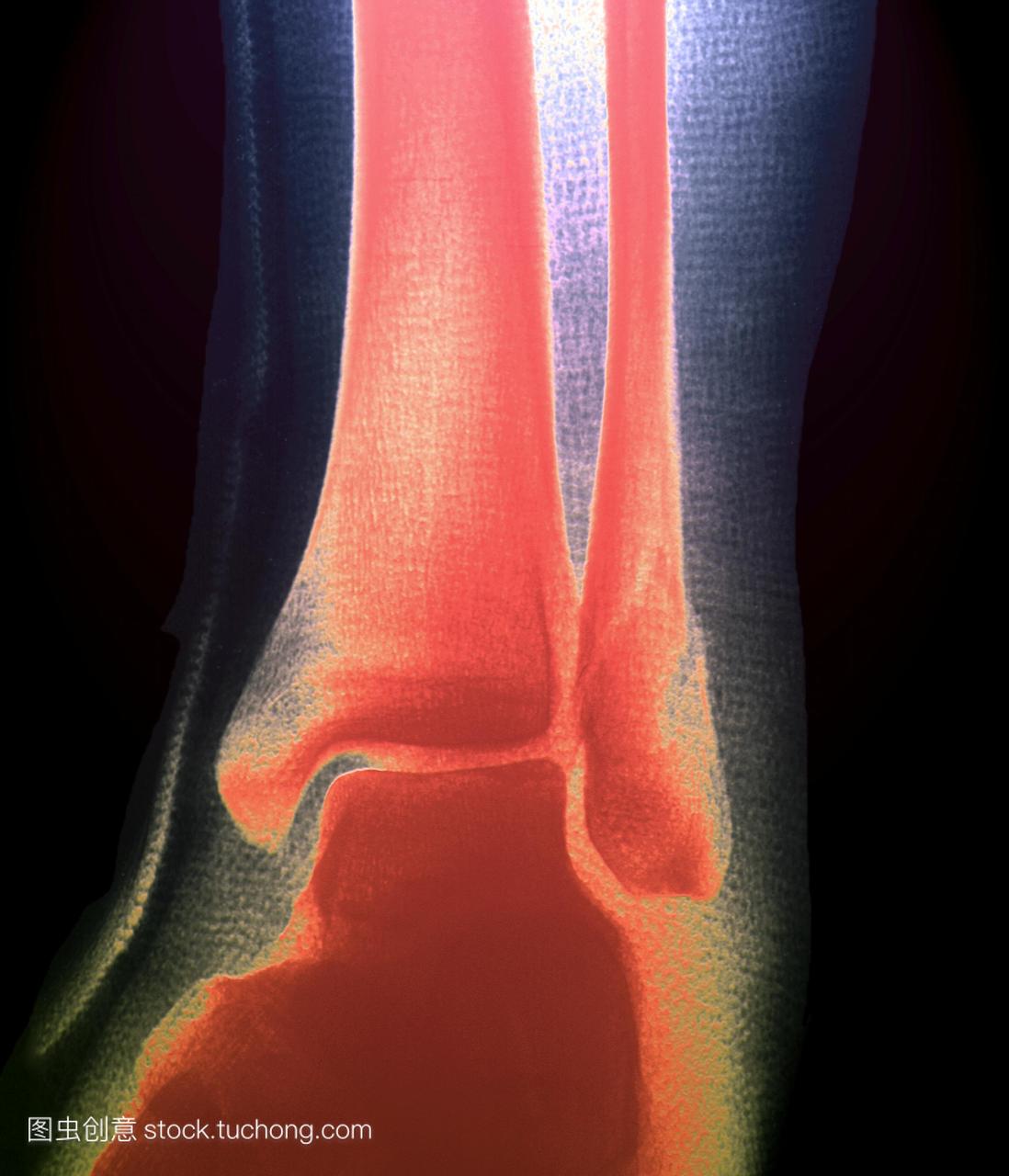 破碎的小腿骨头。彩色的x射线的病人的左脚踝