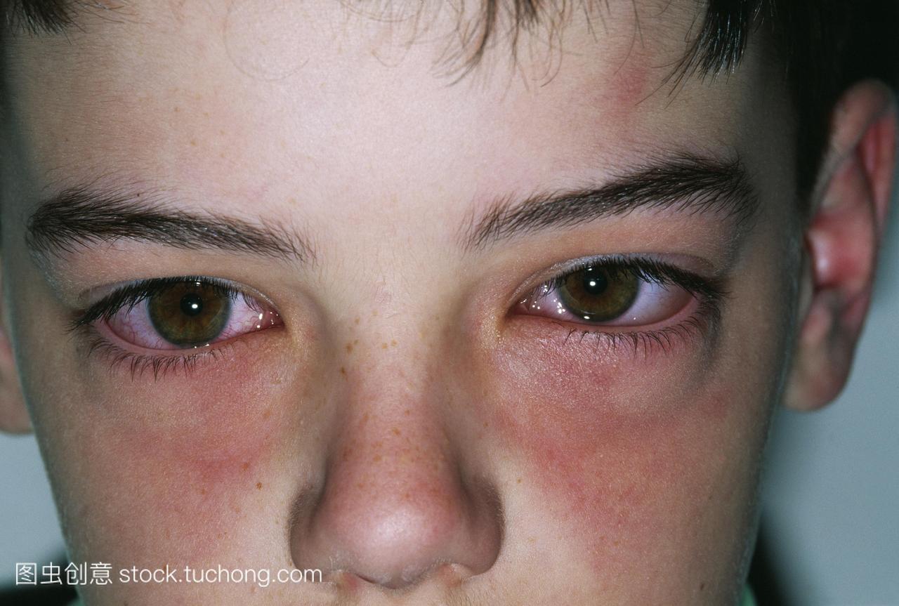 肿胀的眼睛一个10岁的男孩严重花粉过敏。眼
