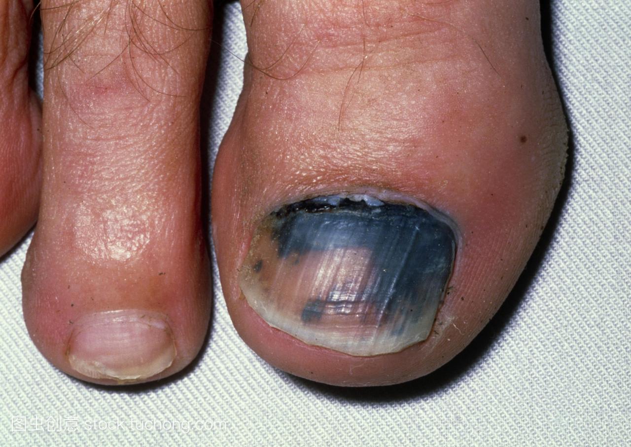 指甲下血肿。在病人大脚趾的指甲下收集血液的