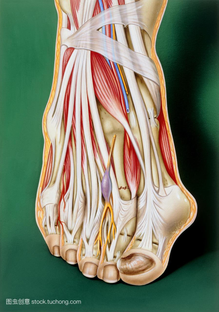 脚紊乱。艺术品的人脚显示障碍应力性骨折莫顿