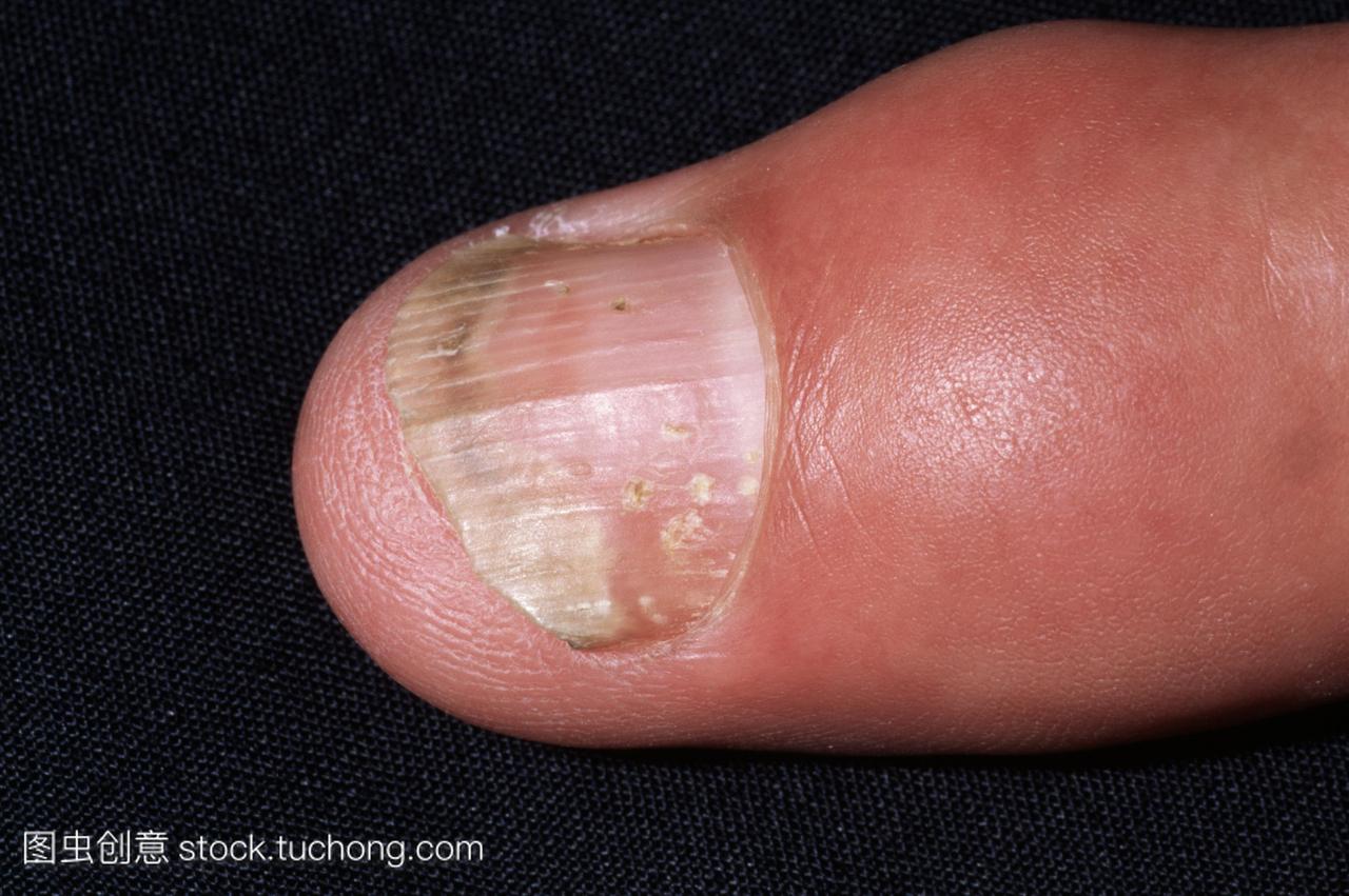 银屑病影响指甲。这种皮肤病使指甲变得麻点,