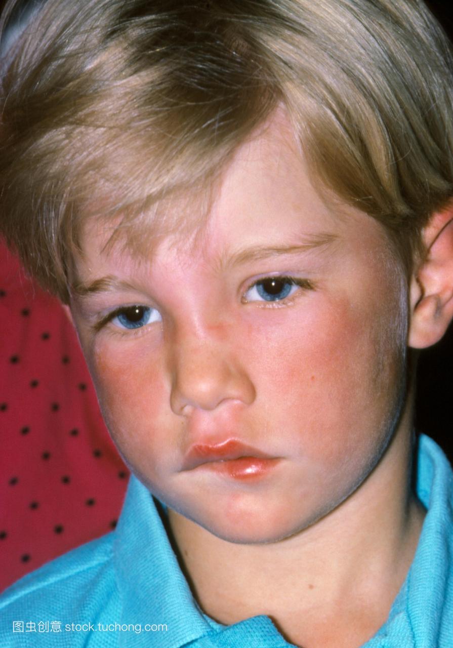 皮肤疾病。受荨麻疹影响的儿童,也被称为荨麻