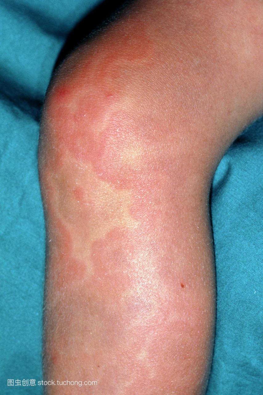 皮肤疾病。受荨麻疹影响的儿童,也被称为荨麻