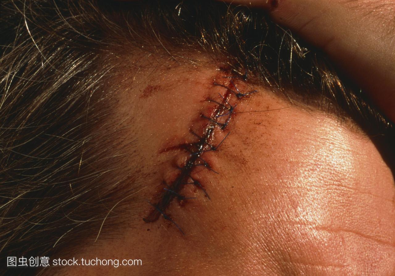 头部受伤。一个男人头皮上的缝合伤口。缝合线