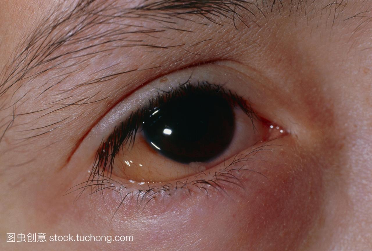 花粉热。病人的眼睛特写显示炎症引起的对花粉