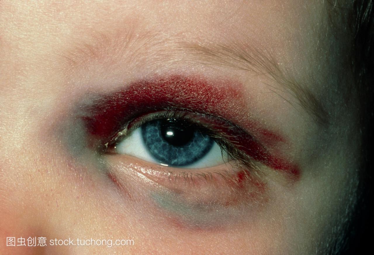 黑眼睛特写的广泛挫伤孩子的左眼周围任何直接