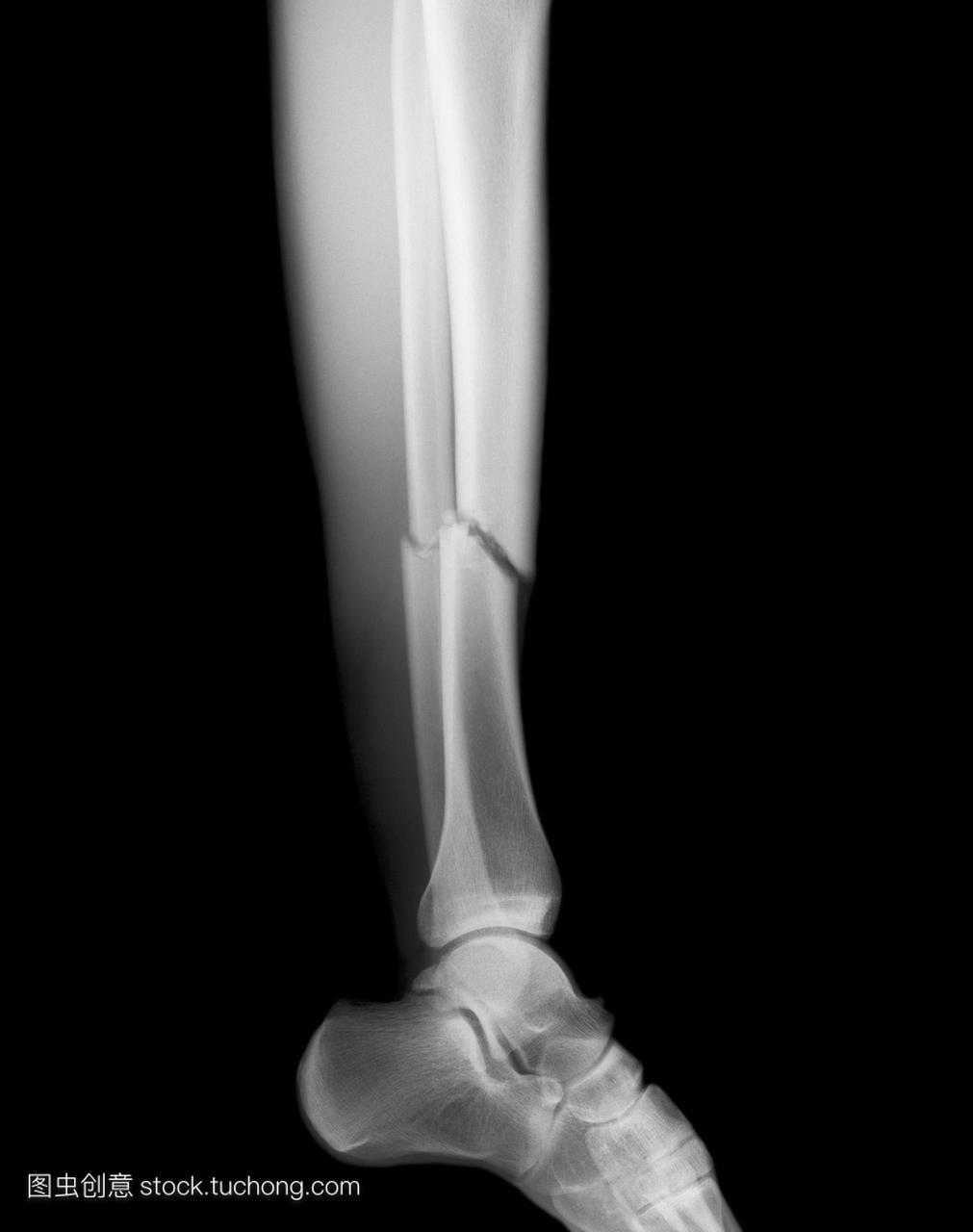 腿部骨折。x光显示多个小腿骨折左中心。胫骨