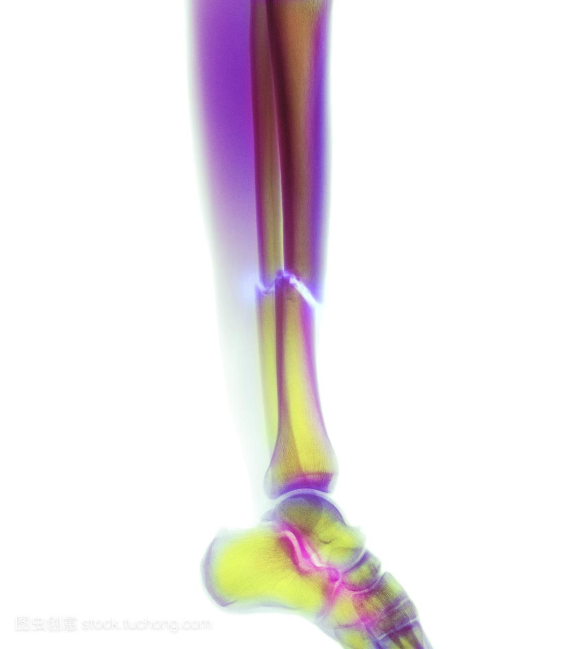 腿部骨折。彩色的x射线显示多个小腿骨折中心