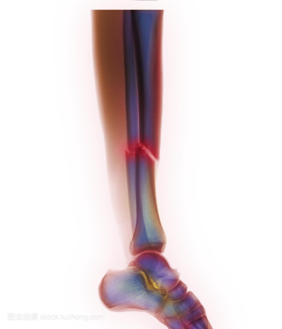 腿部骨折。彩色的x射线显示多个小腿骨折中心