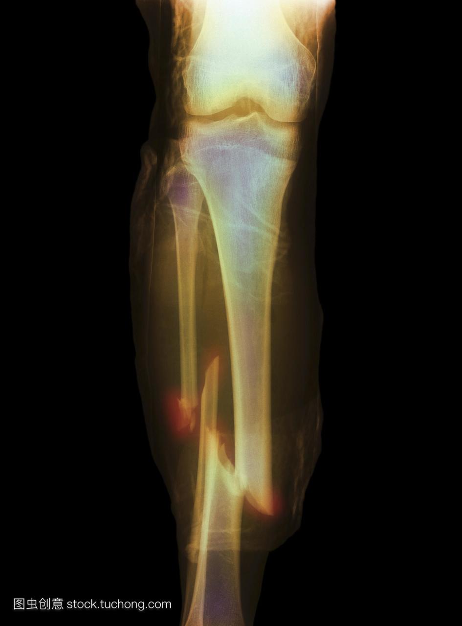 腿部骨折。彩色的x射线显示多个小腿骨折较低