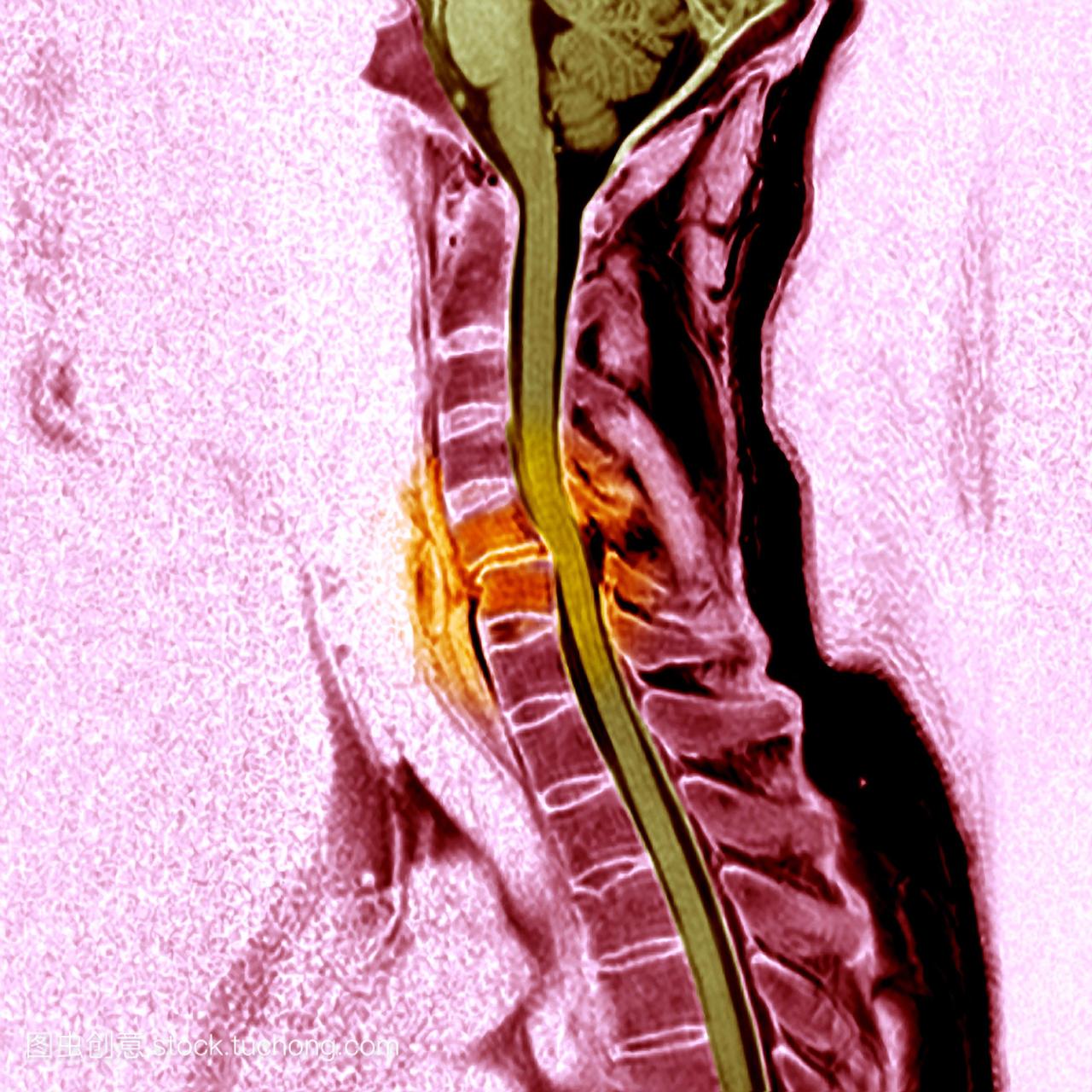 科学照片库折断脖子。彩色的磁共振成像MRI扫