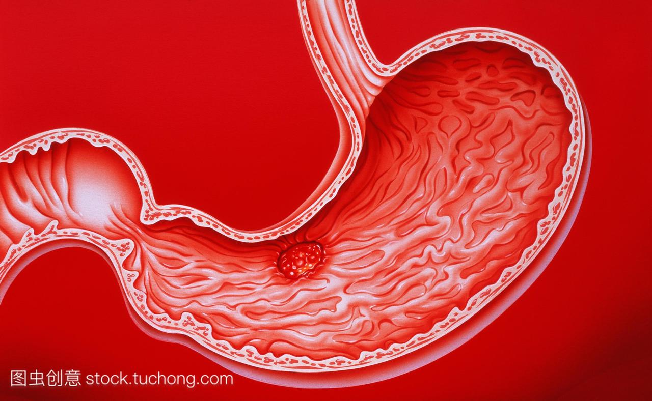 胃溃疡。显示胃胃溃疡深红色的艺术品。也被称