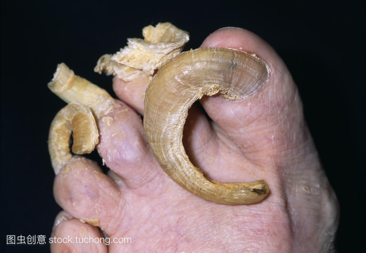 一名78岁妇女的脚趾甲真菌感染癣。指甲变得