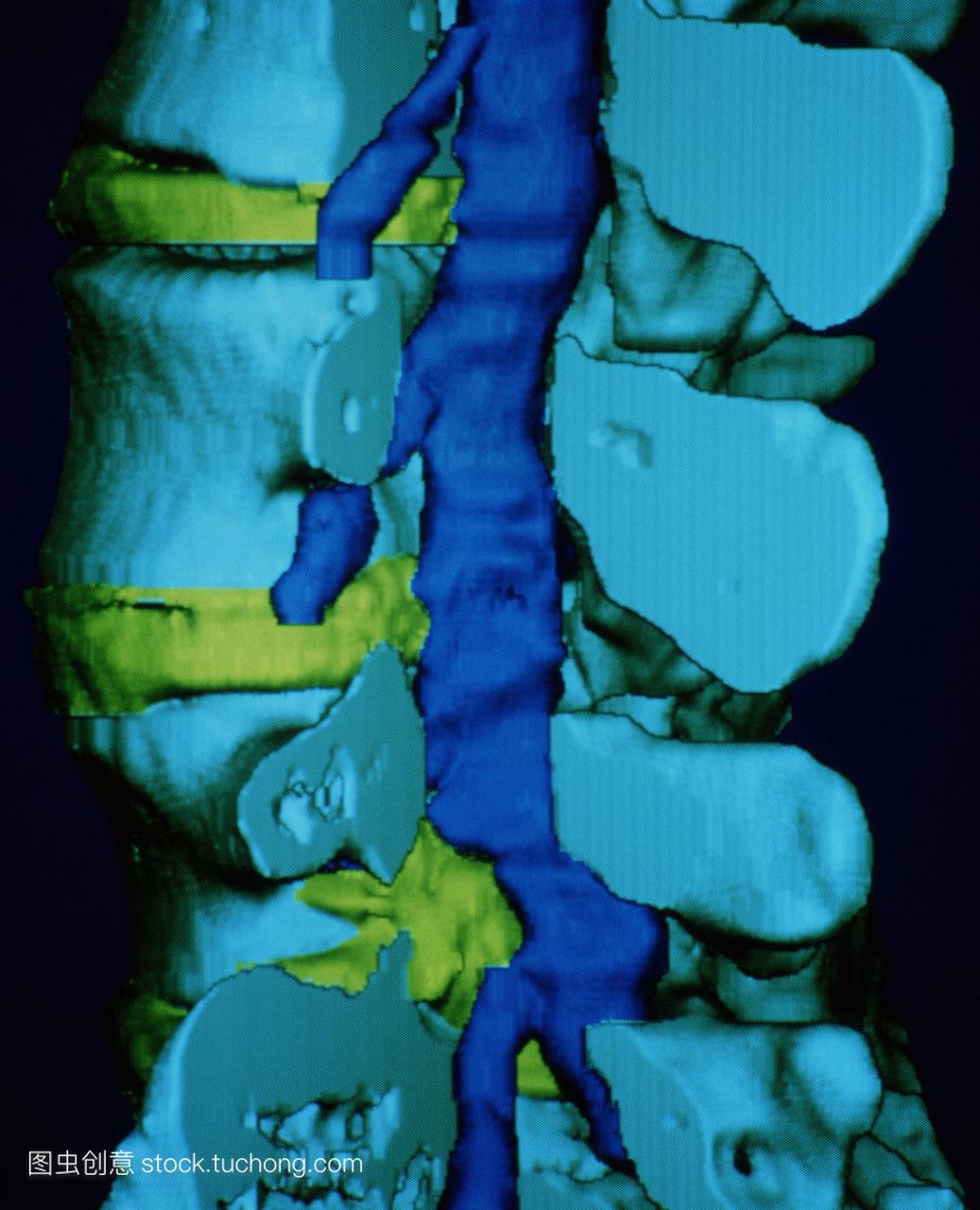 椎间盘突出。彩色三维计算机断层扫描CT扫描