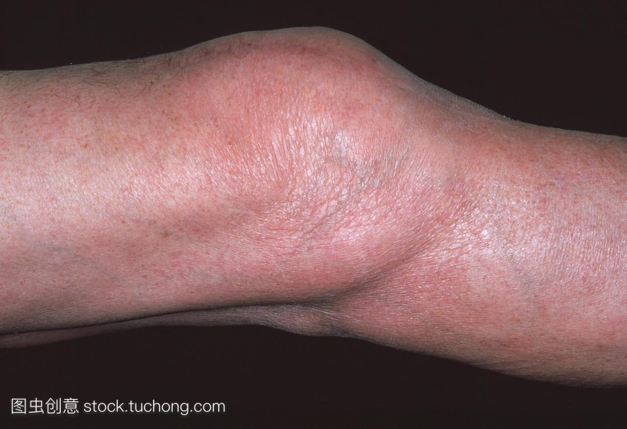 膝关节积液或肿胀的一位74岁的老人的膝盖。