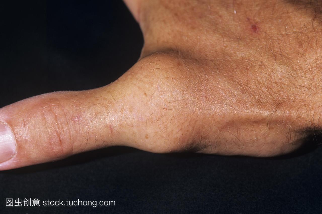 拇指在一名46岁男子的手上肿胀的拇指是由空