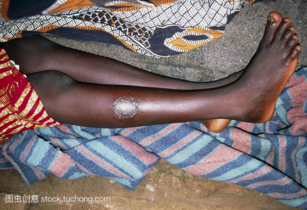 昏睡病。一名少女腿上的疼痛结节,显示出非洲