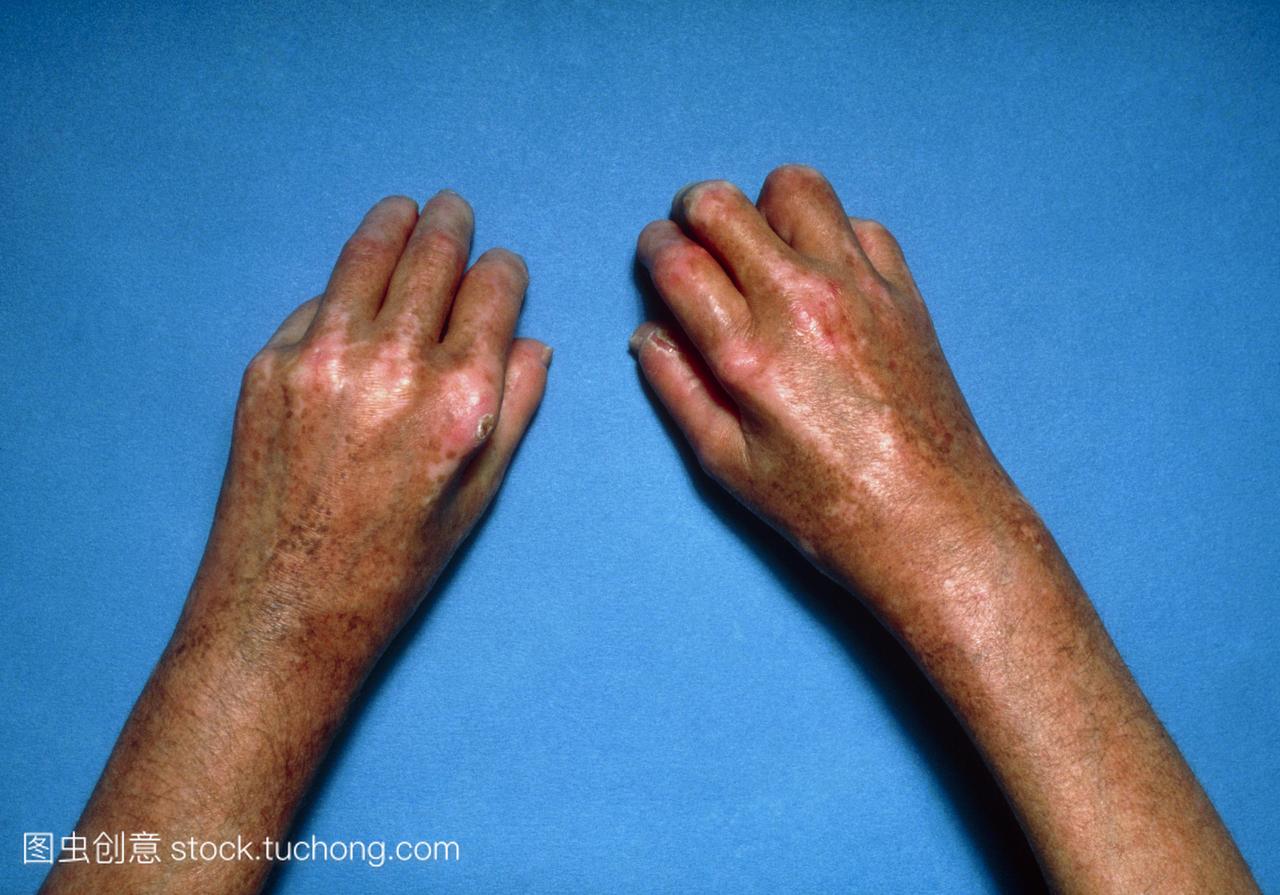 硬皮病。有硬皮病系统性硬化的手部有光泽的皮
