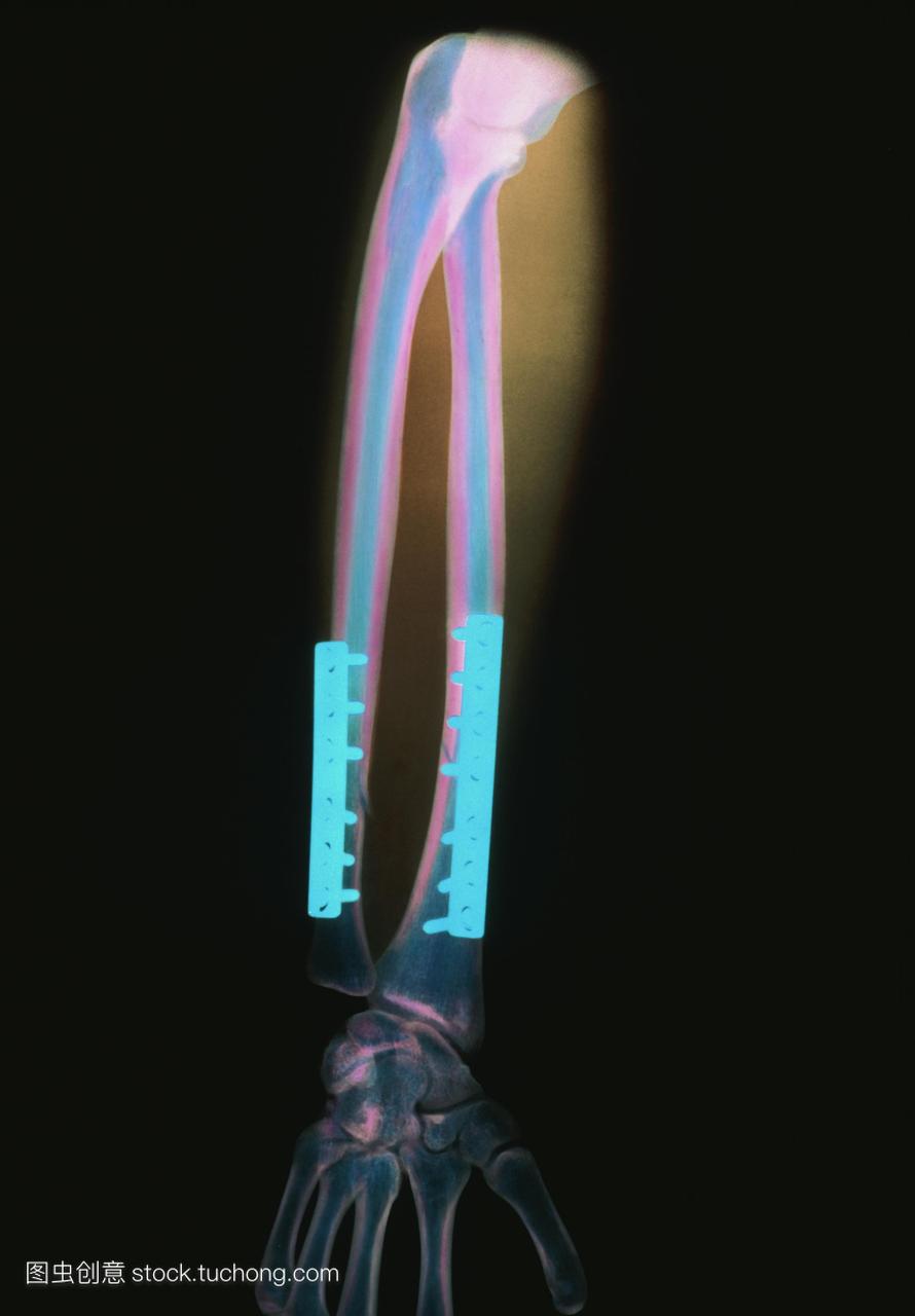 固定手臂骨折的x光显示钢钉固定的复合断裂半