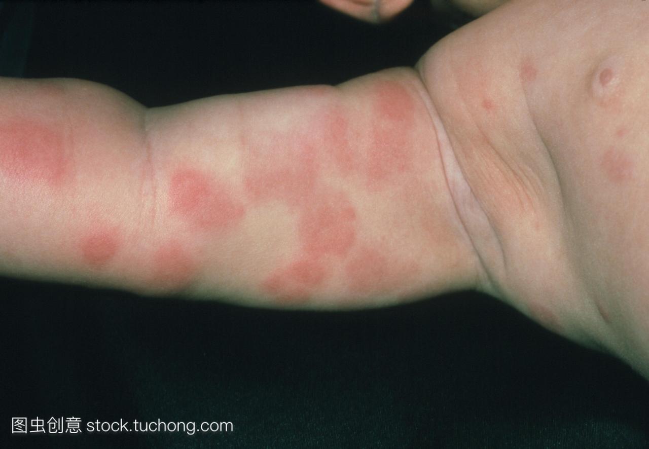 从食物过敏皮疹。手臂的红疹出现在4个月大的