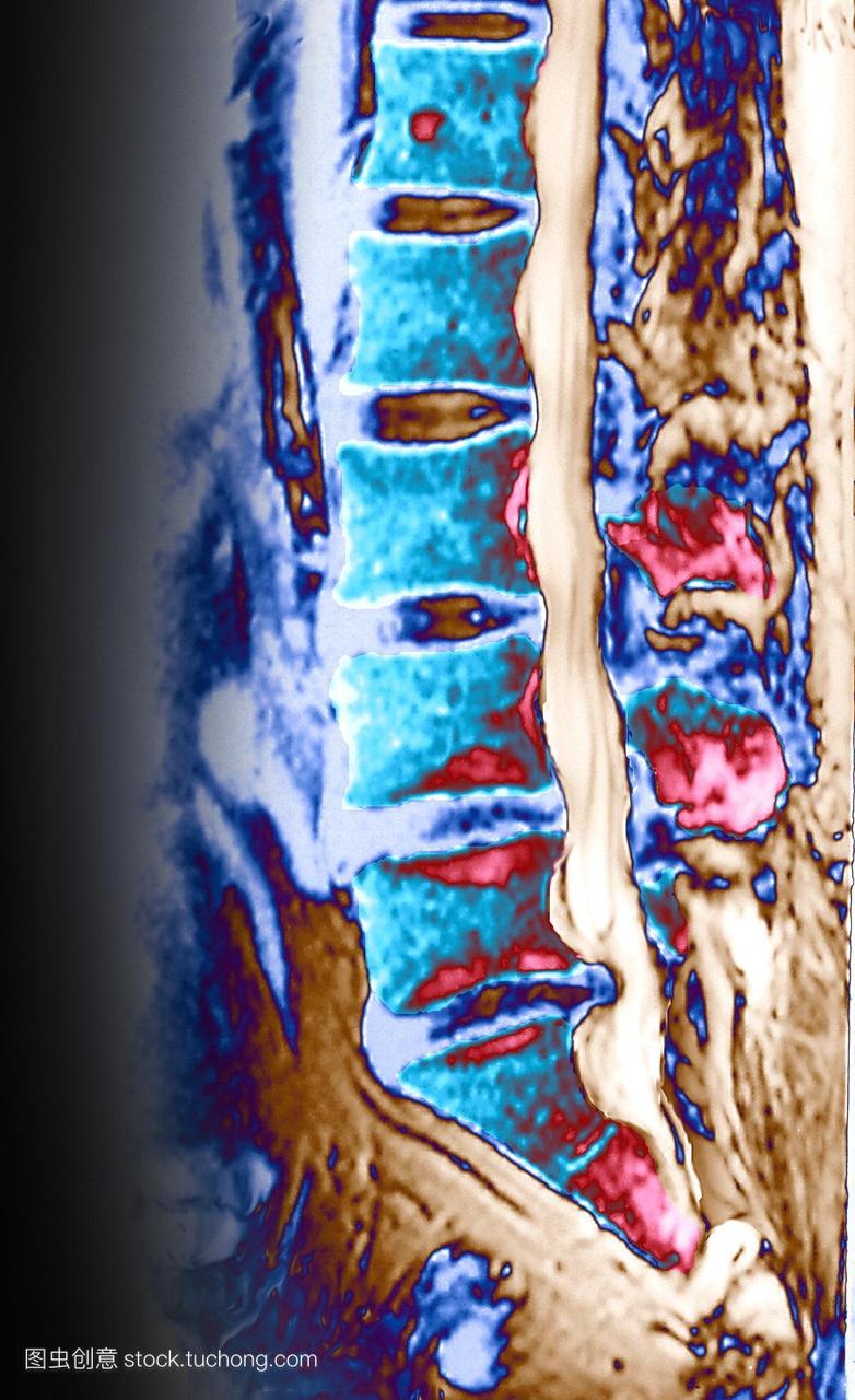人患有脊椎滑或椎间盘突出。中部深蓝,右下的